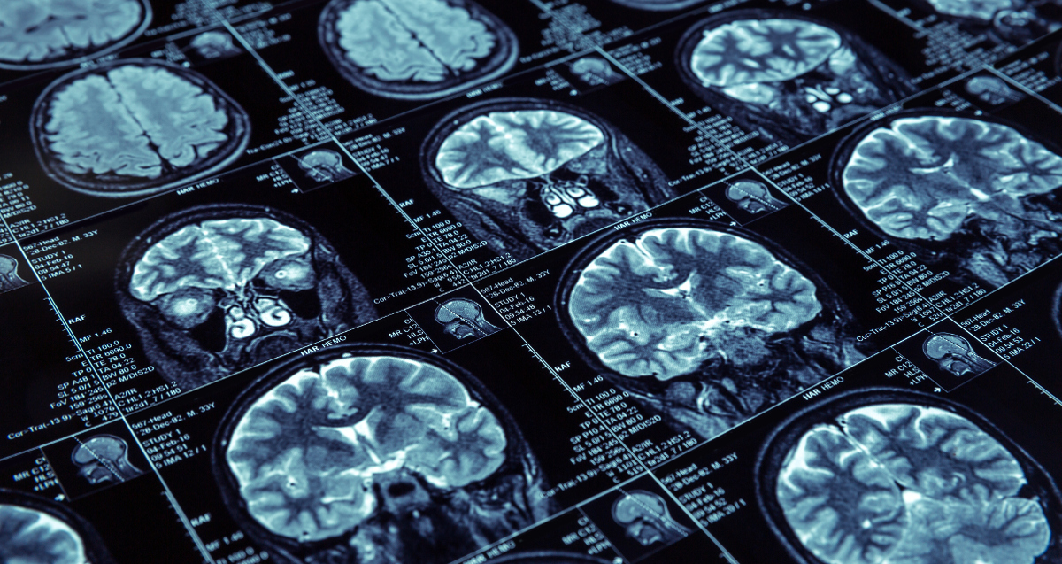 Le neurorecrutement consiste à embaucher ses employés après un visionnage de leur IRM et des test psychologiques. Alors, idée de génie ou discrimination ?